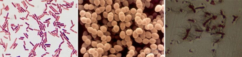 Sticks de Escherichia, Enterococcus fecal y pro - los principales patógenos de la prostatitis bacteriana crónica