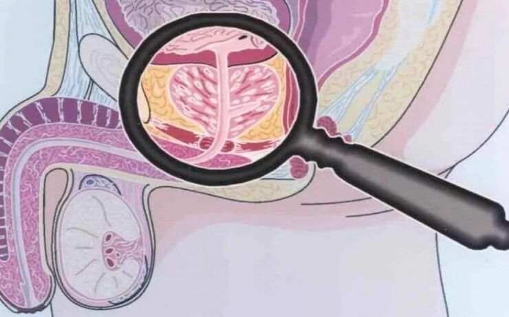 Prostatitis crónica