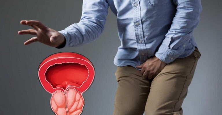 Prevención de prostatitis y adenoma de próstata
