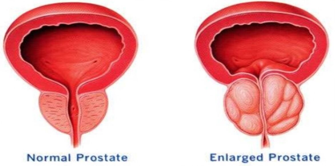 Próstata normal, próstata inflamada